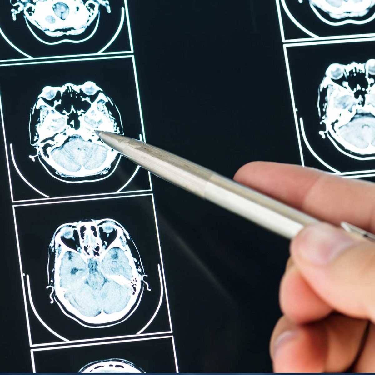 Neurofisiología en la Clínica Ponferrada Neurofisiología en la Clínica Ponferrada