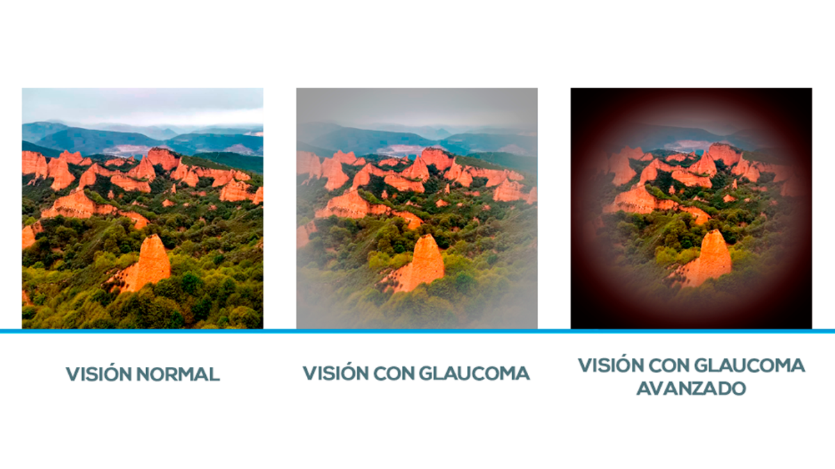 Dia-Mundial-Glaucoma-2024-Recoletas-Salud-1200x675.png